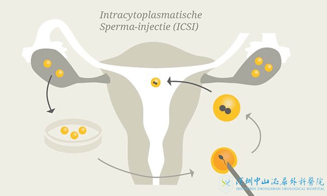 Intra-cytoplasmic Sperm Injection(ICSI)